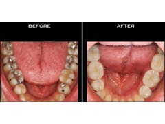 Restorations