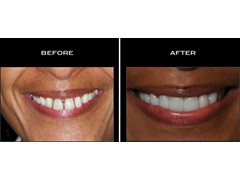 Smile Designing